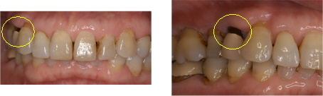 【診療前画像】歯の根元が黒いのが気になると来院された50代女性